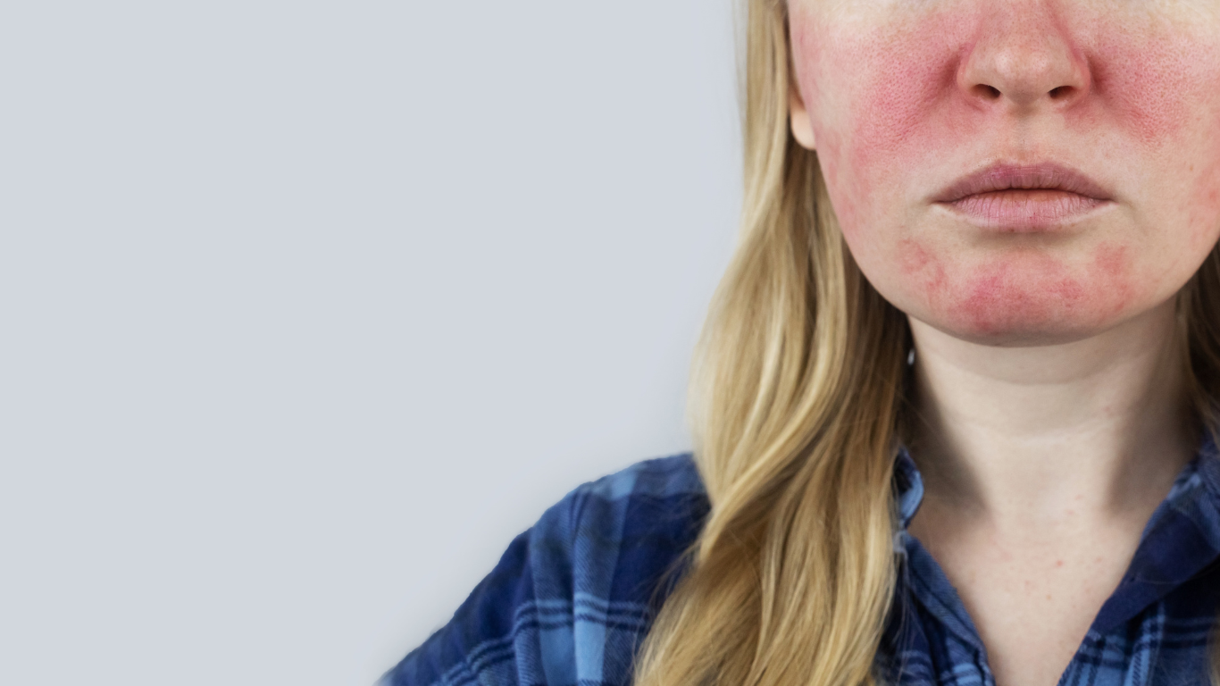 Rosacea