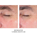 Before and after comparison of eye area skin treatment showing reduced fine lines from Skinbetter Alpharet Eyemax