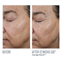 Before and after comparison of using Skinbetter Ampra Volume HA Serum