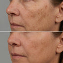before and after use of cloud vitamin a cream