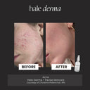 Before and after acne skin comparison with Hale Derma spray product on a black background
