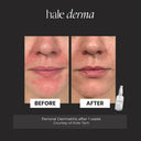 Before and after comparison of perioral dermatitis with a bottle labeled 'hale derma' on a black background.