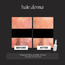 Before and after comparison of rosacea skin with a bottle labeled 'hale derma' on a black background.