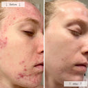 Before-and-after split screen comparison of a woman's face showing acne and redness improvement, with 'Before' on the left and 'After' on the right from using Omnilux LED face mask