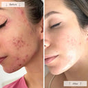 Before and after comparison of a person's face with acne improvement from Omnilux LED face mask