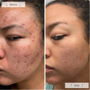Before and after close-up facial photos of a woman showing acne improvement, with the left side labeled 'Before' and the right side labeled 'After' from using Omnilux LED face mask