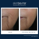 SkinBetter InterFuse® Intensive Treatment LINES