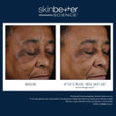 A before-and-after comparison of a person's face showing skin improvement using skinbetter mystro active balance serum with the text 'skinbetter SCIENCE' at the top and 'BASELINE' and 'AFTER 12 WEEKS, TWICE-DAILY USE*' below the photos. The image is branded with skinbetter science and includes small disclaimer text at the bottom.