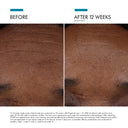 skinceuticals-ptiox-before-after