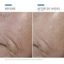 Before and after comparison of skin texture improvement over 20 weeks using Skinceuticals C E Ferulic vitamin C serum