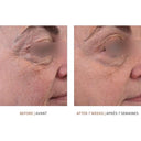 vivier grenzcine eye before and after photos