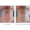 vivier grenzcine neck before and after pics